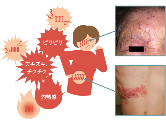 New 帯状疱疹 はまくぼクリニック 相模原市橋本の内科 消化器科 外科