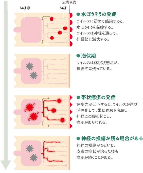 イラスト：発症のメカニズム