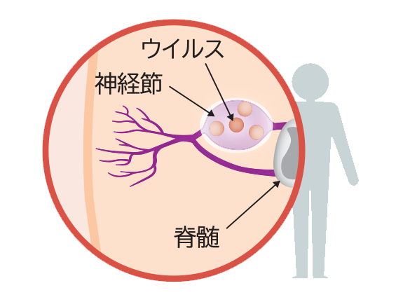 イラスト：潜伏感染